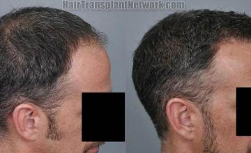 Before and after surgical hair restoration images