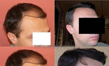 Hair transplantation surgery before and after photos