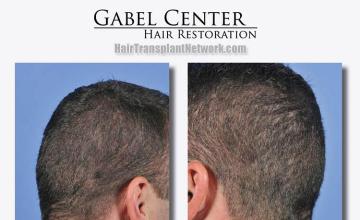 Surgical hair transplantation result photographs