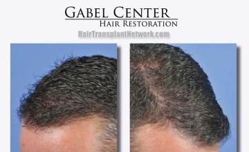 Hair replacement surgery before and after images