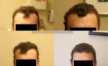 Hair restoration procedure before and after results