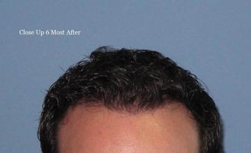 Hair restoration procedure front closeup image