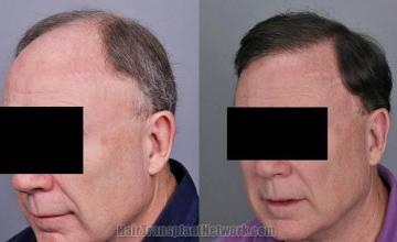 Hair transplantation surgery before and after pictures