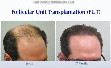 Hair transplantation surgery before and after photos