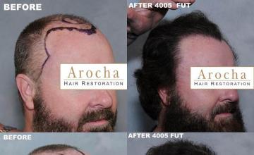 Hair transplantation surgery before and after images
