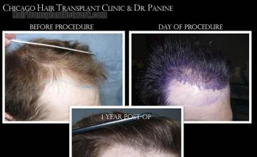 Hair transplantation surgery before and after photos