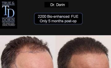 Hair transplantation surgery before and after images