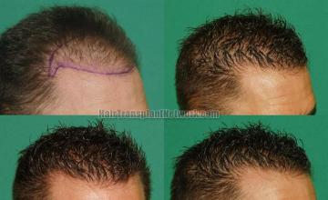 Hair restoration procedure before and after pictures