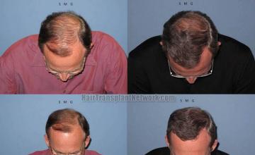 Hair restoration procedure before and after pictures