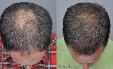 Hair replacement surgery before and after images