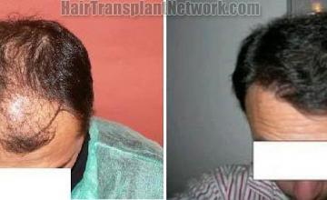 Hair restoration procedure before and after results