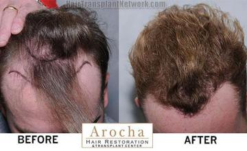 Hair replacement surgery before and after images