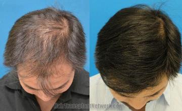 Hair restoration procedure before and after results