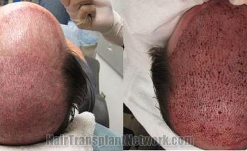 Hair restoration procedure before and after result images