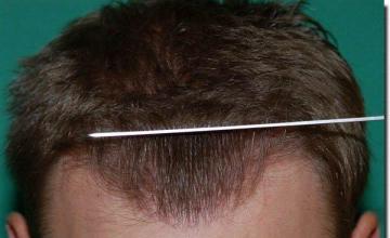 Hair restoration procedure results