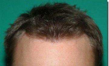 Hair restoration procedure results