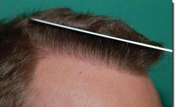 Hair restoration procedure results