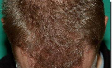 Hair restoration procedure results