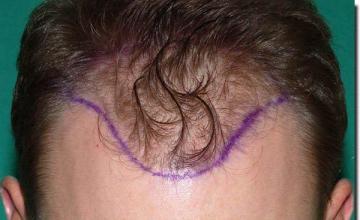 Hair restoration procedure results