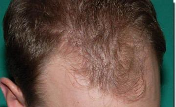 Hair restoration procedure results