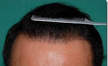 Hair restoration procedure results
