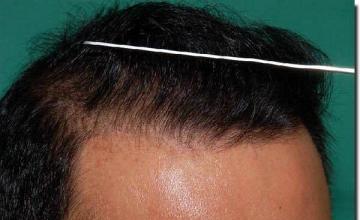 Hair restoration procedure results