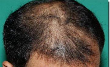 Hair restoration procedure results