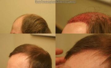 Hair transplantation surgery before and after photos