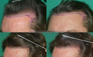 Hair transplantation surgery before and after photos