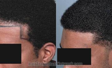 Hair transplantation surgery before and after images