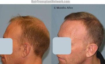 Hair transplantation surgery before and after pictures