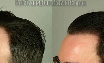 Hair restoration procedure before and after pictures