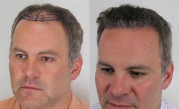 Hair transplantation surgery before and after pictures