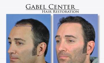 Hair transplantation surgery before and after pictures