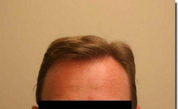 Hair restoration procedure results