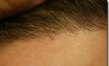 Hair restoration procedure results