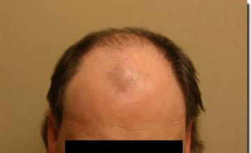 Hair restoration procedure results