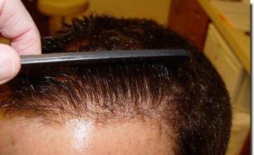 Hair restoration procedure results