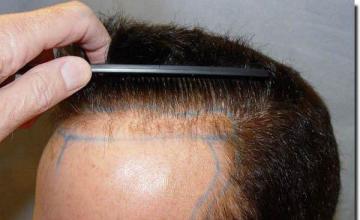 Hair restoration procedure results