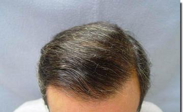 Hair restoration procedure results