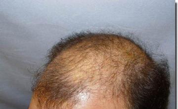 Hair restoration procedure results