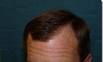 Hair restoration procedure results