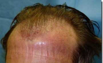 Hair restoration procedure results