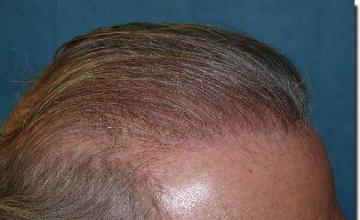 Hair restoration procedure results