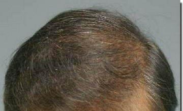 Hair restoration procedure results