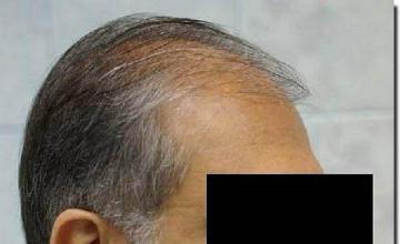 Hair restoration procedure results