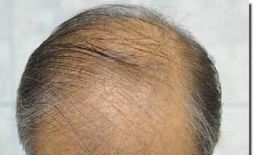 Hair restoration procedure results