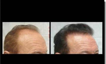 Hair restoration procedure results