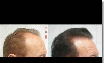 Hair restoration procedure results