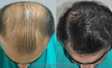 Hair restoration procedure before and after results